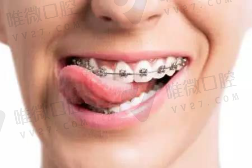 牙齿胶托是什么（单颗胶托义齿）